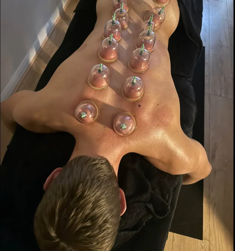 Glass cups placed along a client's back during a dry cupping session