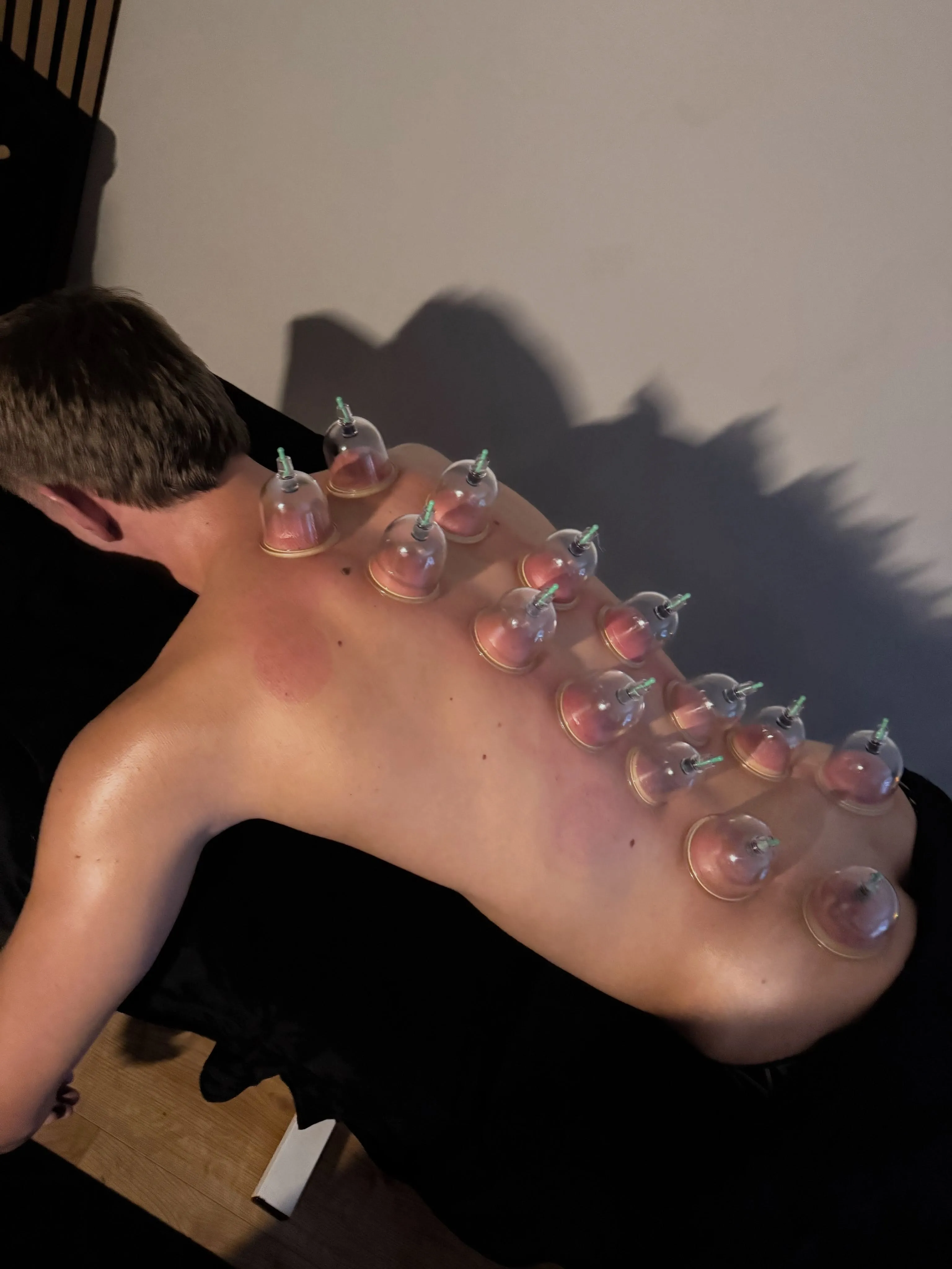 Glass cups placed along a client's back and shoulder