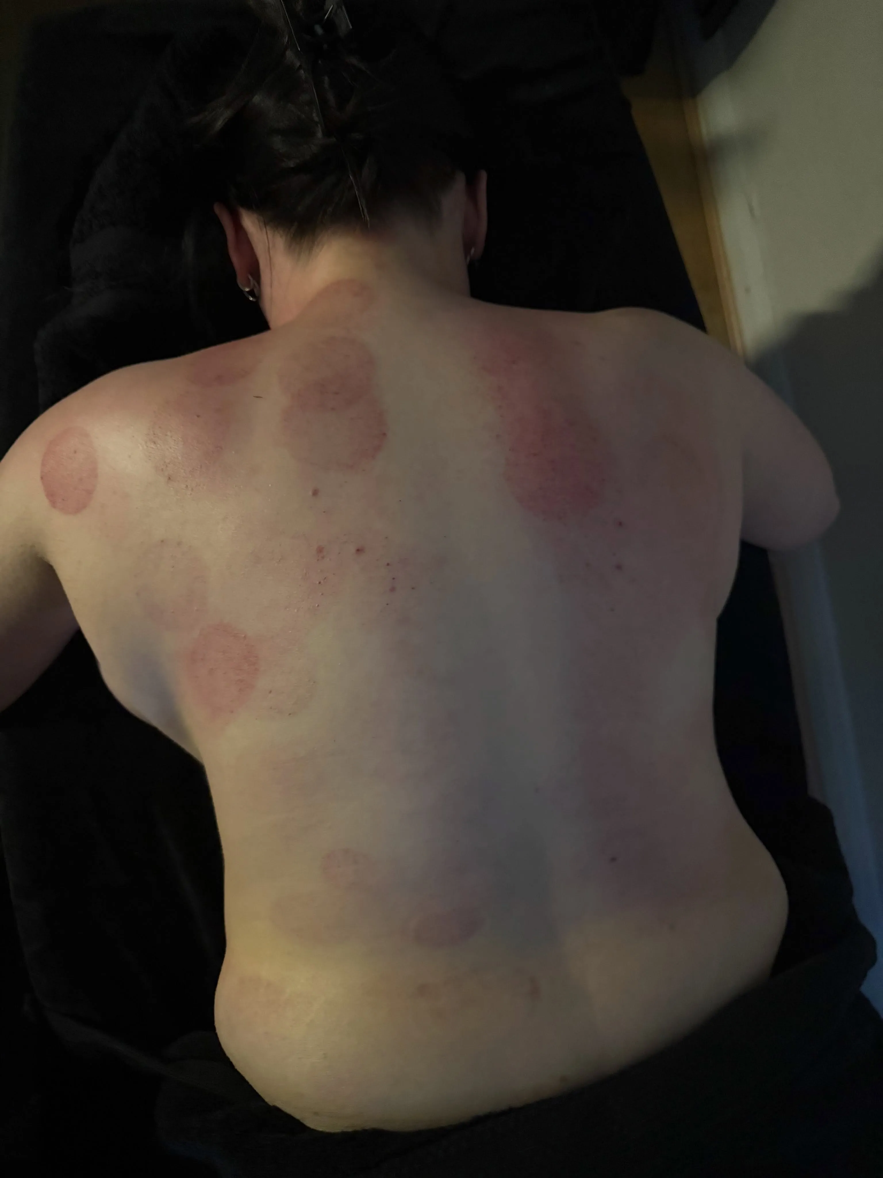 Circular marks across a client's back after dry cupping